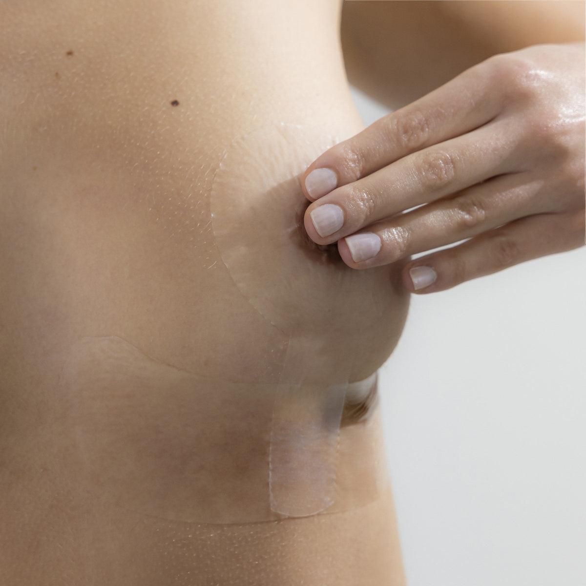 Cerederm Anchor silicone dressing applied on periareolar and vertical breast surgery scars